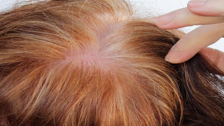 Well Being Benefits of PRP Treatment For Hair Loss